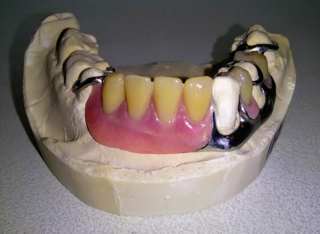 Metal Partial Denture for lingual tilted teeth (special case)