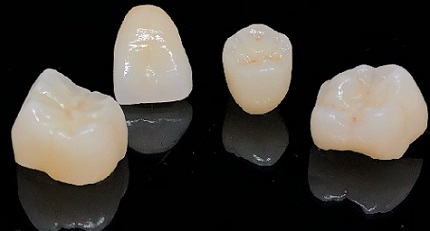 Porcelain fused to zirconia crowns
